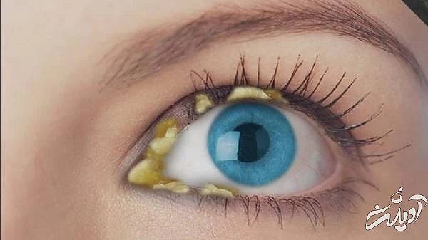 ترشح چشم و سلامتی رنگ ترشح چشم